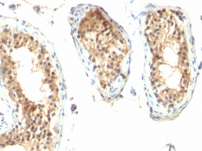 Formalin-fixed, paraffin embedded human testicular carcinoma sections stained with 100 ul anti-Ornithine Decarboxylase-1 (clone ODC1/485) at 1:200. HIER epitope retrieval prior to staining was performed in 10mM Citrate, pH 6.0.